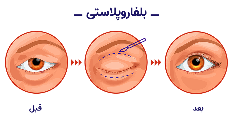 بلفاروپلاستی در اصفهان 