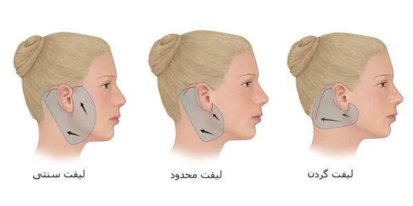 جراحی لیفت صورت و گردن در اصفهان