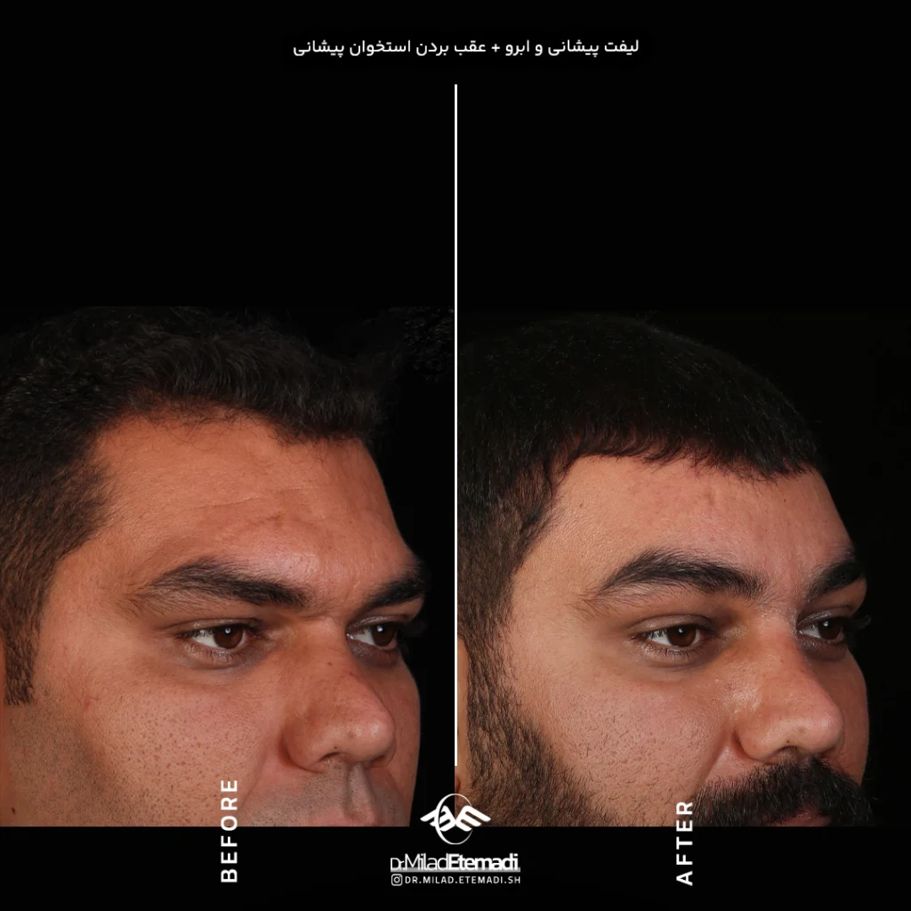 لیفت صورت و گردن در اصفهان