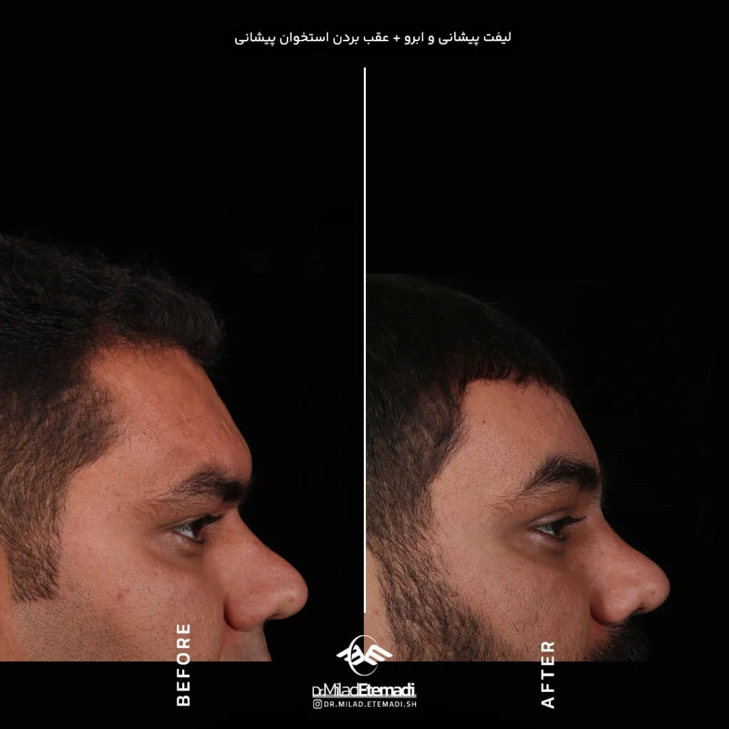  لیفت صورت و گردن در اصفهان