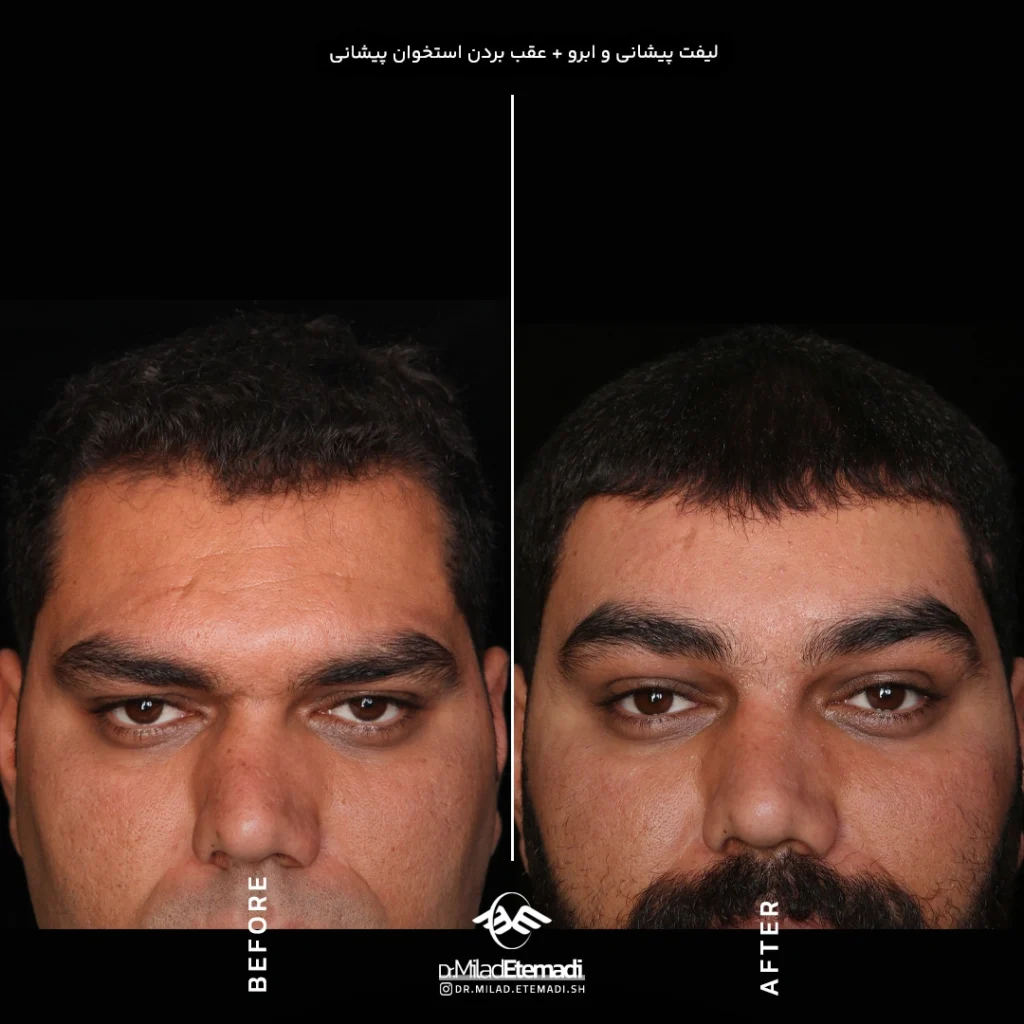 لیفت صورت و گردن در اصفهان
