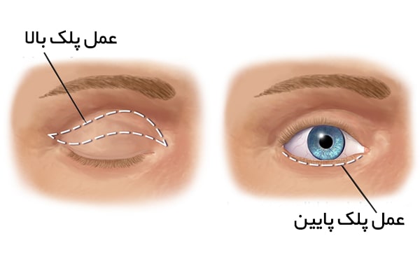 بلفاروپلاستی در اصفهان 