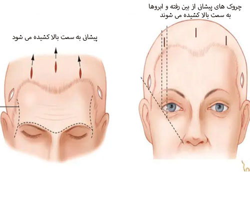 لیفت پیشانی در اصفهان 