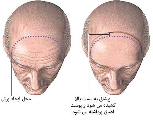 لیفت پیشانی در اصفهان 