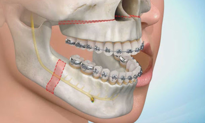 آیا جراحی فک خطرناک است