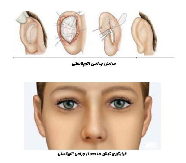 سوالات متداول جراحی اتوپلاستی