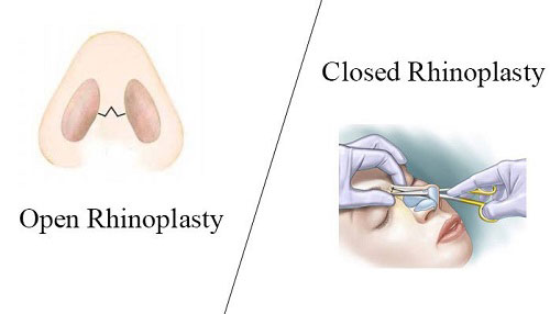 جراحی بینی به روش بسته چگونه است؟