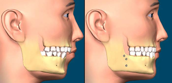 جراحی فک برای ارتودنسی