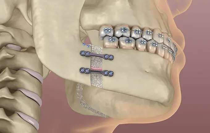 جراحی فک برای ارتودنسی