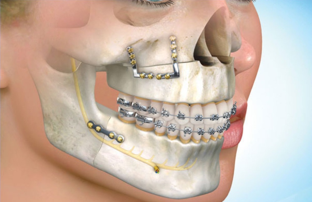 جراحی فک برای ارتودنسی