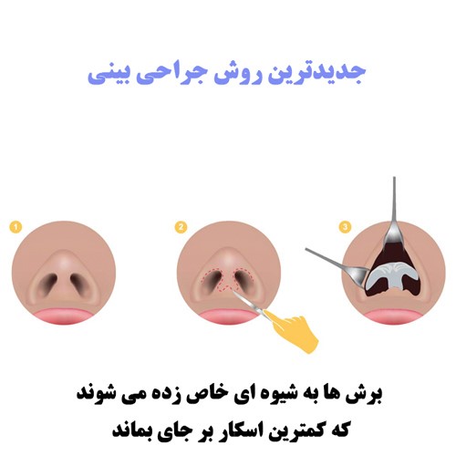 جراحی بینی به روش بسته چگونه است؟