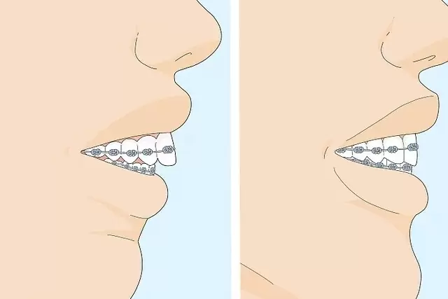 جراحی فک پایین عقب رفته