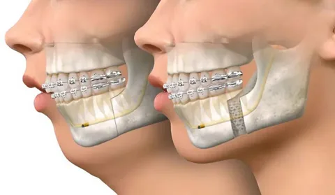 جراحی فک پایین عقب رفته