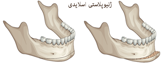 جراحی ژنیوپلاستی چیست