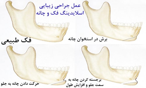 جراحی ژنیوپلاستی چیست