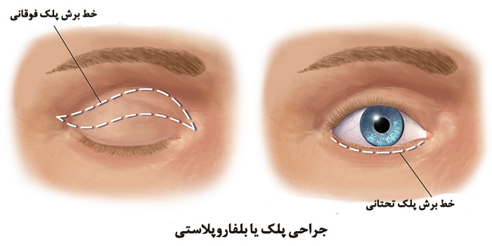 بلفاروپلاستی با لیزر بهتره یا جراحی