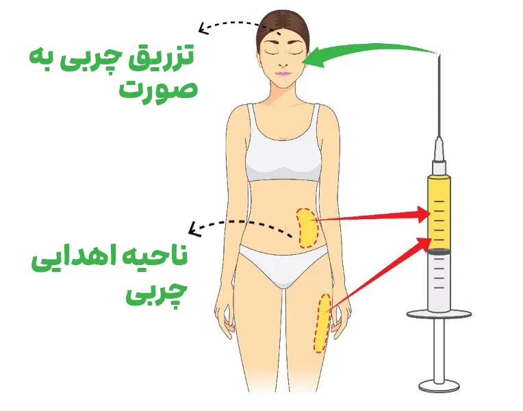 ماندگاری تزریق چربی به صورت لاغر