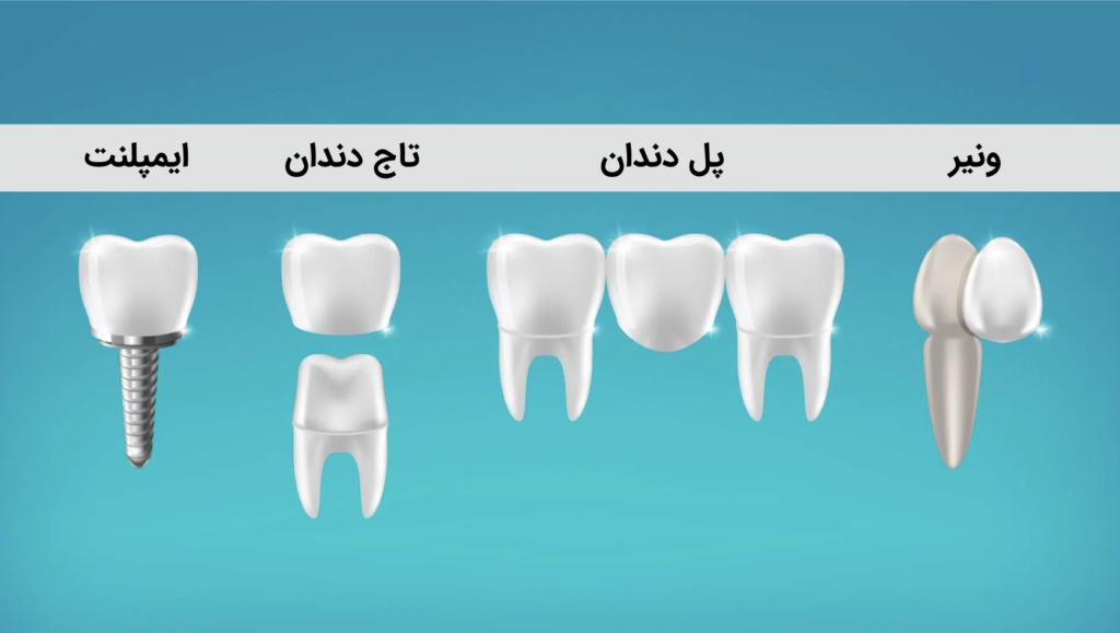 چه زمانی دندان باید ایمپلنت شود