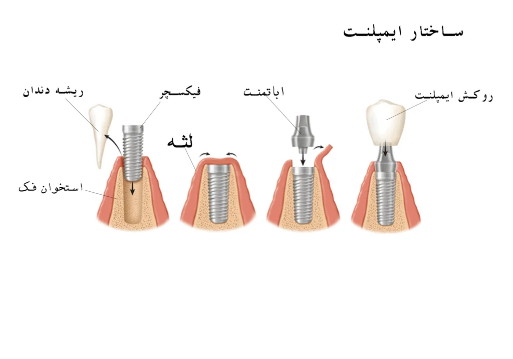ایمپلنت دندان در اصفهان