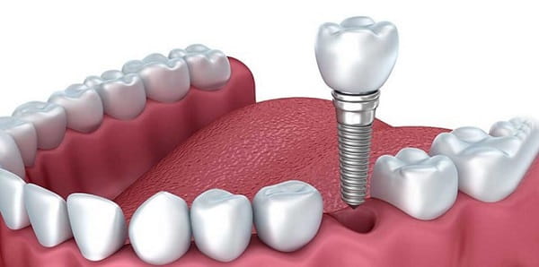 چه زمانی دندان باید ایمپلنت شود