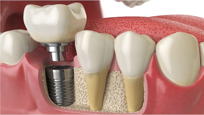 آیا ایمپلنت دندان باعث سرطان می شود