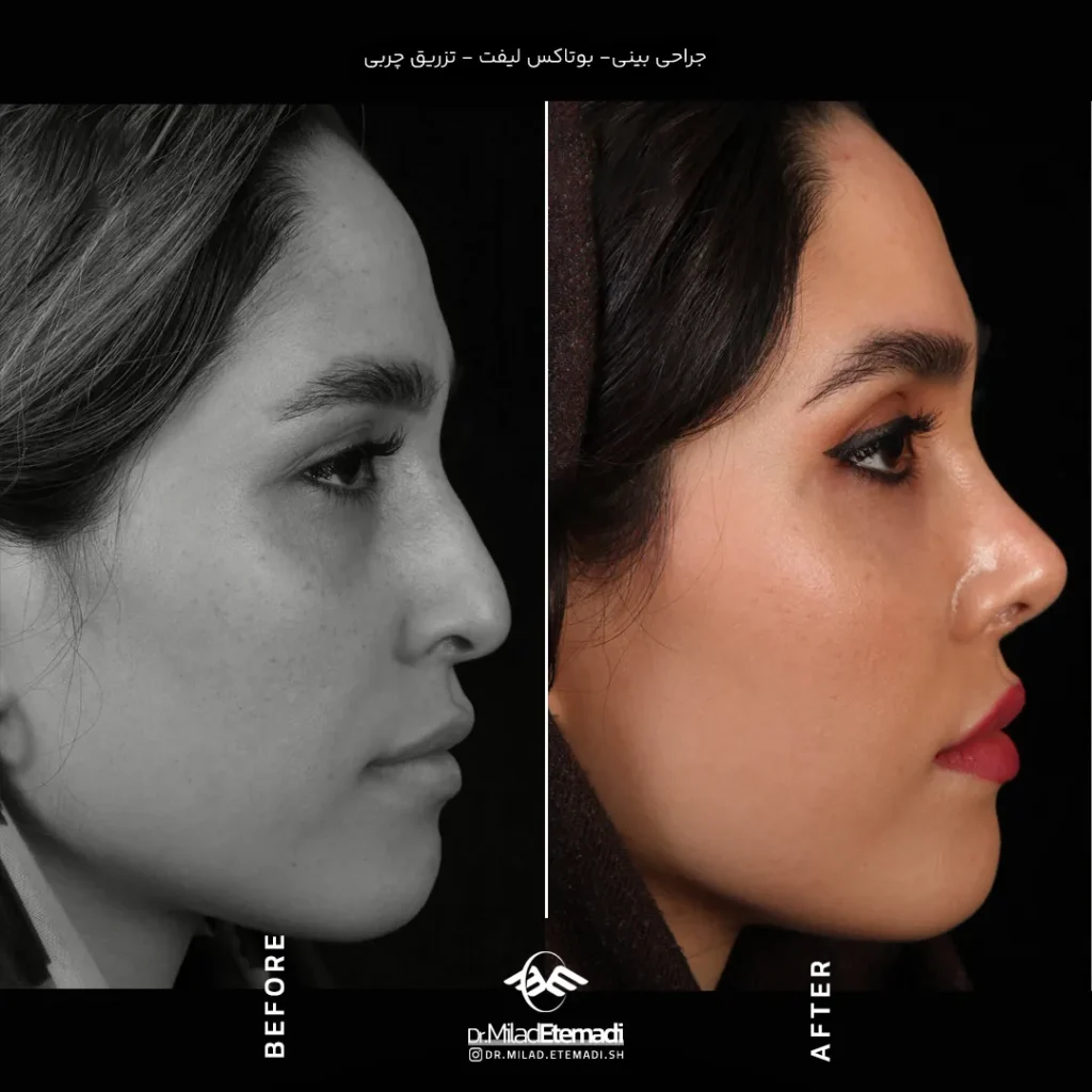 جراحی بینی عروسکی در اصفهان