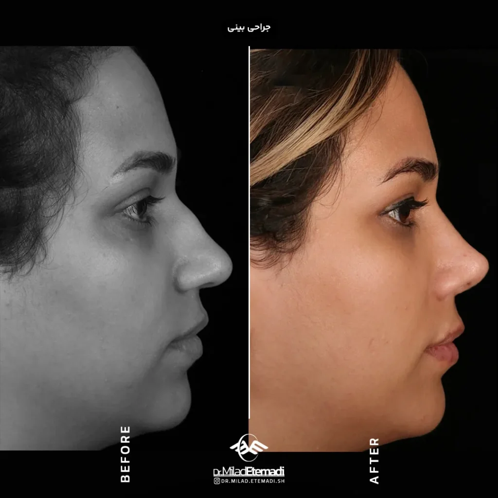 جراحی بینی عروسکی در اصفهان