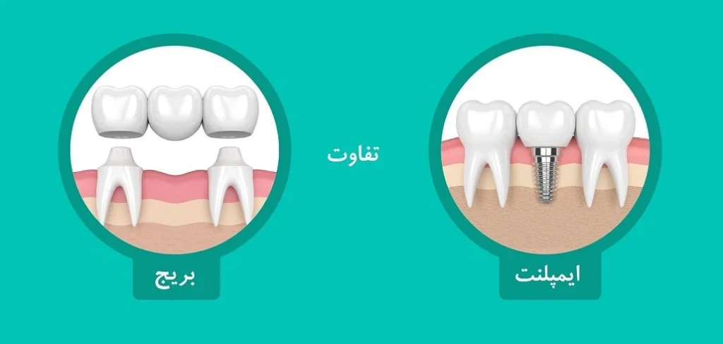 مقایسه ایمپلنت و بریج دندان 