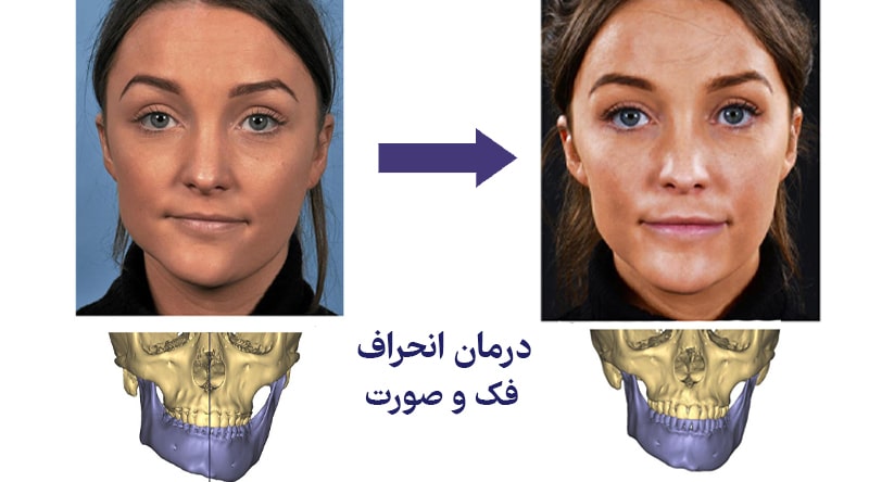 انحراف فک چیست