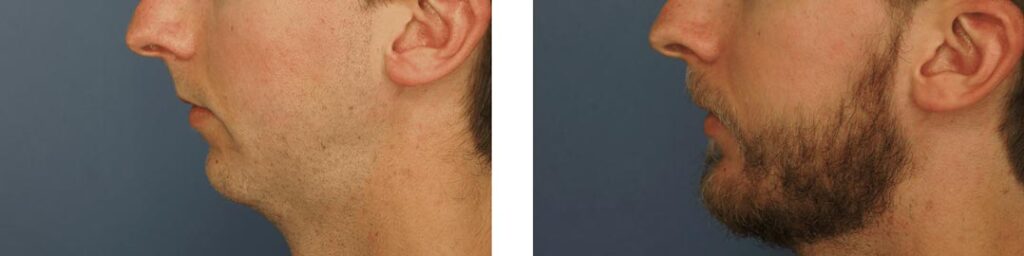 برای زاویه سازی صورت ژل بهتر است یا چربی