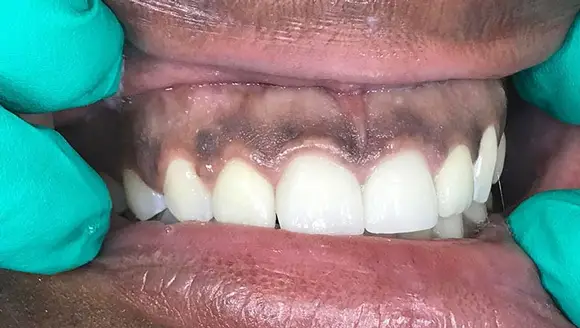 سیاه شدن لثه بعد از ایمپلنت