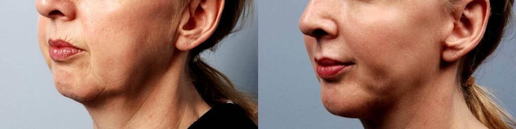 برای زاویه سازی صورت ژل بهتر است یا چربی