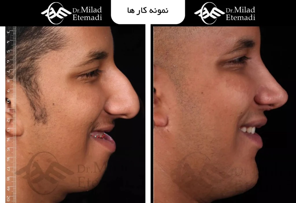 حرف زدن بعد از جراحی فک