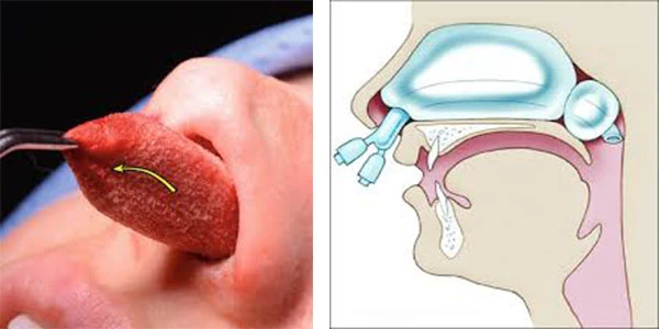 خونریزی بعد از عمل بینی خطرناک است؟