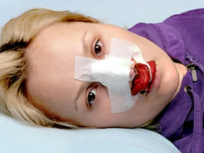 خونریزی بعد از عمل بینی خطرناک است؟