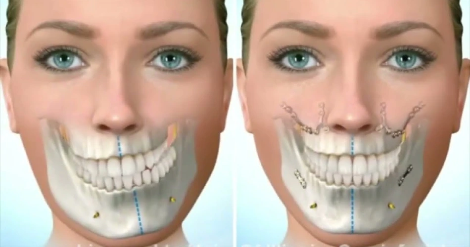 آیا انحراف فک قابل درمان است؟