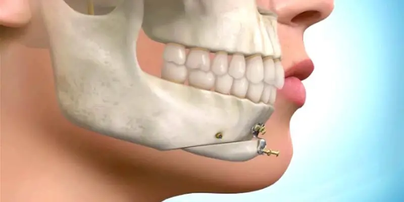 چه فک هایی نیاز به جراحی دارند؟