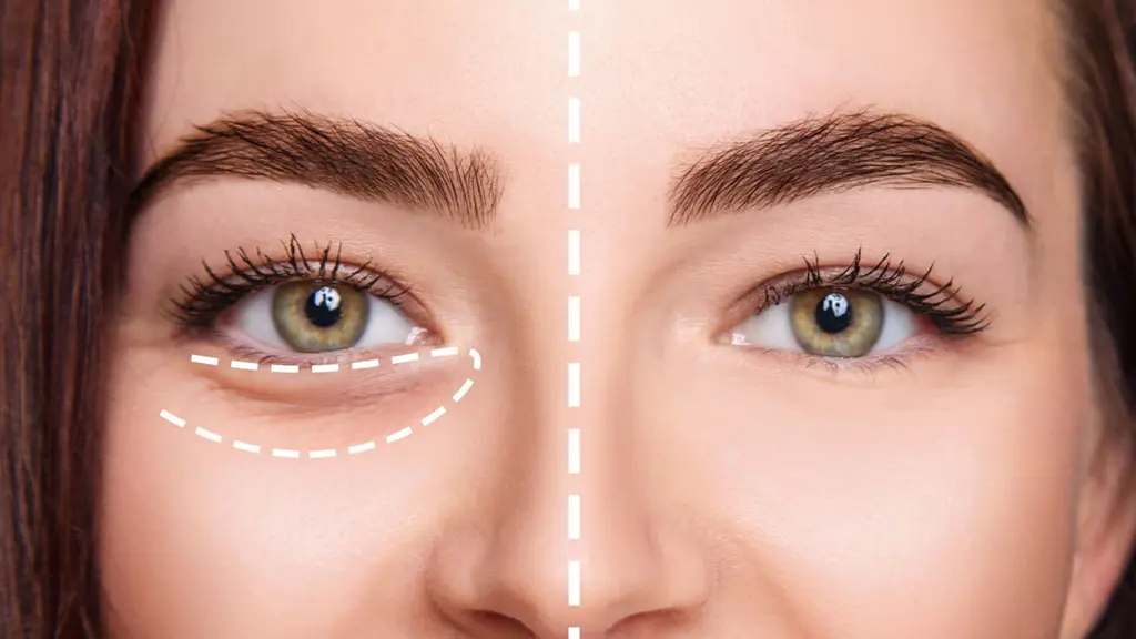 ماندگاری تزریق چربی به زیر چشم