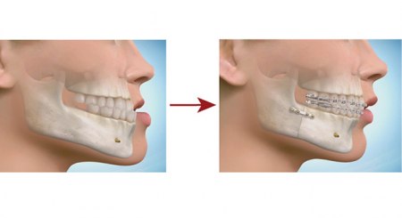 چه فک هایی نیاز به جراحی دارند؟