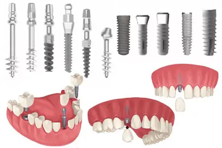 فاصله بین کشیدن دندان و کاشت ایمپلنت چقدر است