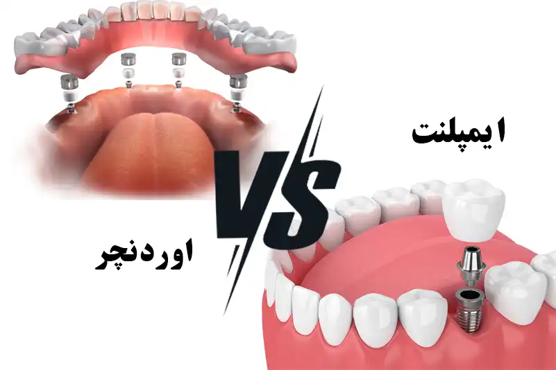 تفاوت اوردنچر و ایمپلنت دندان
