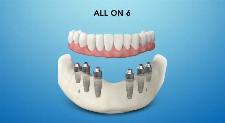 All-on-6 چیست