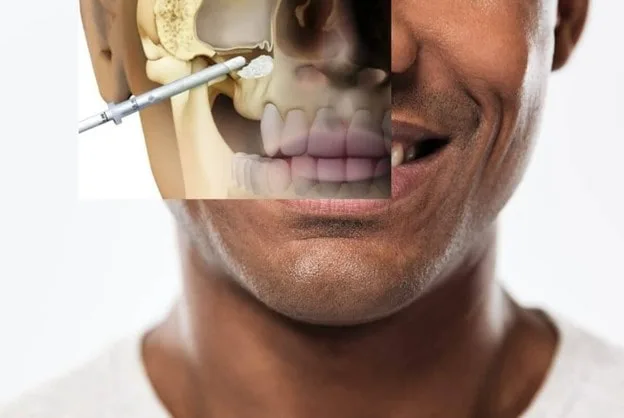 چه زمانی جراحی لیفت سینوس واجب است؟