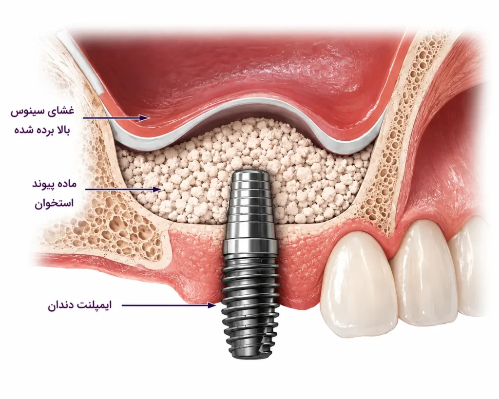 چه زمانی جراحی لیفت سینوس واجب است؟