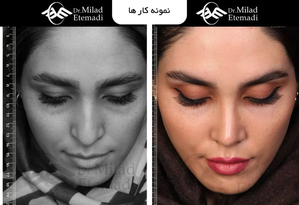 لیفت پیشانی یا بلفاروپلاستی