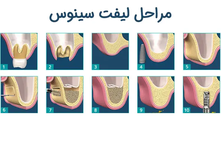 لیفت سینوس چگونه انجام میشود؟