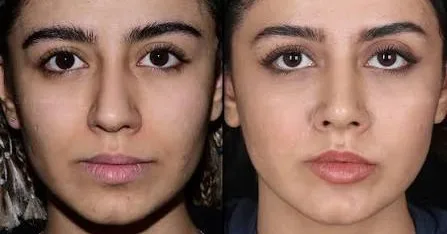 جراحی بینی به سبک V چیست