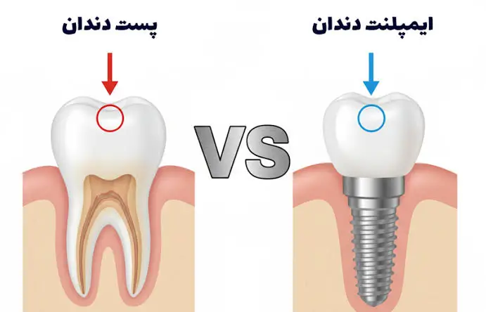 پست و روکش دندان بهتر است یا ایمپلنت؟