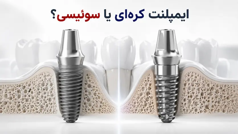 مقایسه ایمپلنت سوئیسی و کرهای