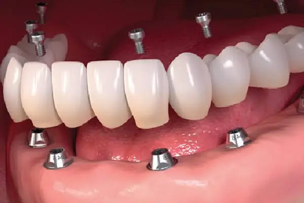 ایمپلنت به روش پانچ چیست؟